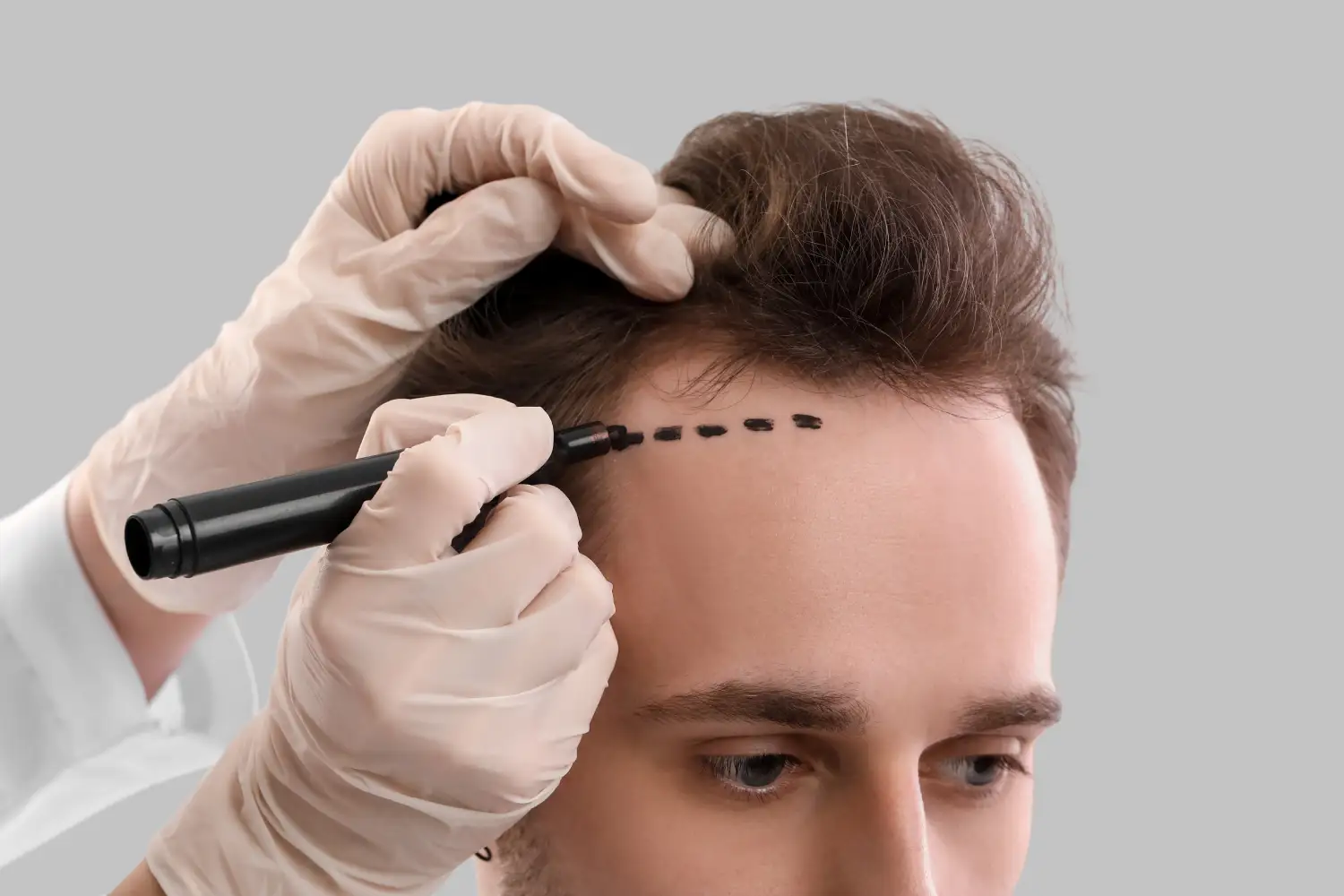 Haarausfall Nürnberg: PRP, Minoxidil & Co. – Was ist die beste Lösung?