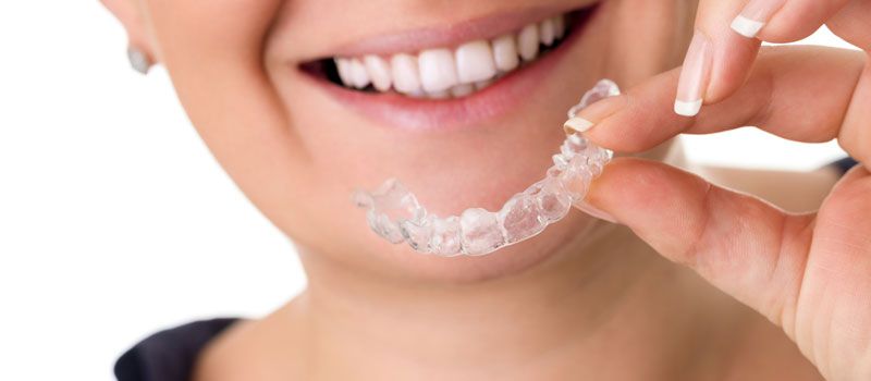 Transparente Aligner für einen geschäftigen Lebensstil: Komfort und Flexibilität